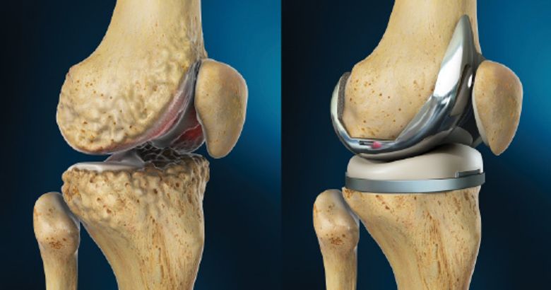 6 signes qui indiquent qu'il faut vraiment subir une arthroplastie du genou