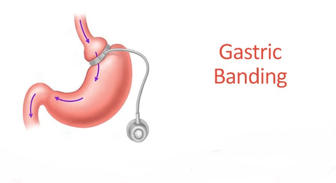 gastric-banding-cost-in-india