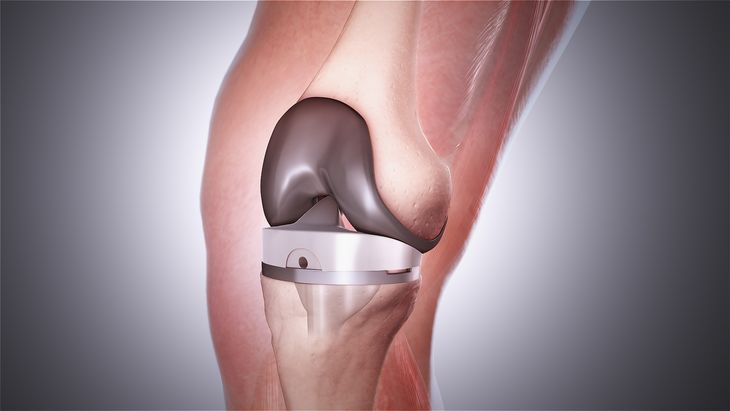 success-rate-knee-replacement-india