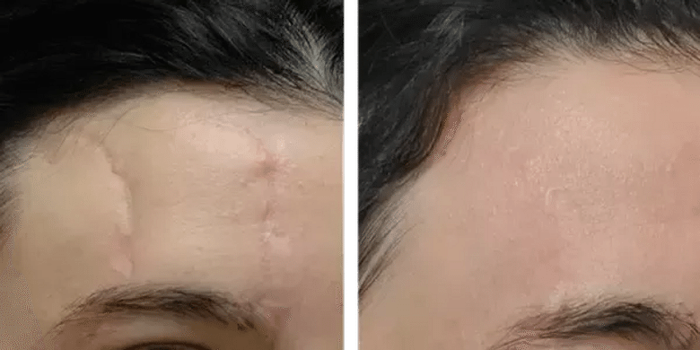 laser-scar-removal-surgery