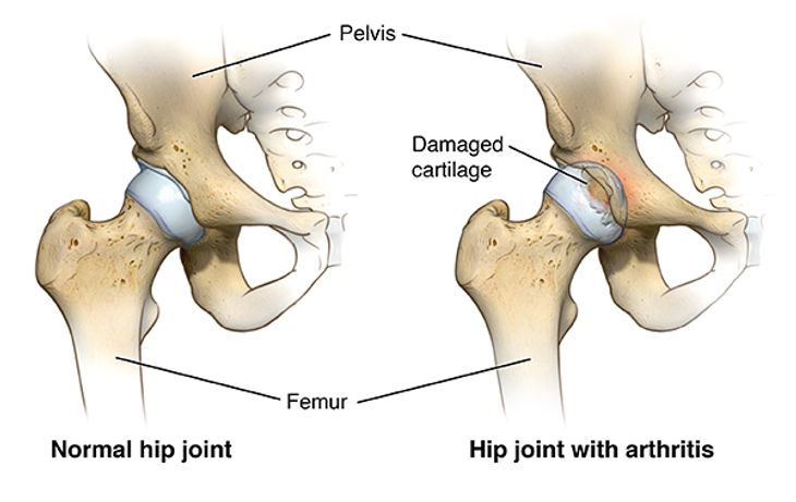 hip-joint-replacement-india