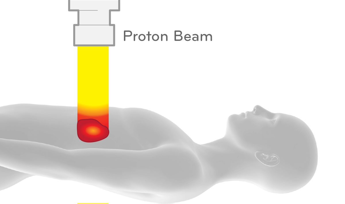 стоимость-протон-терапия-индия-топ-центры