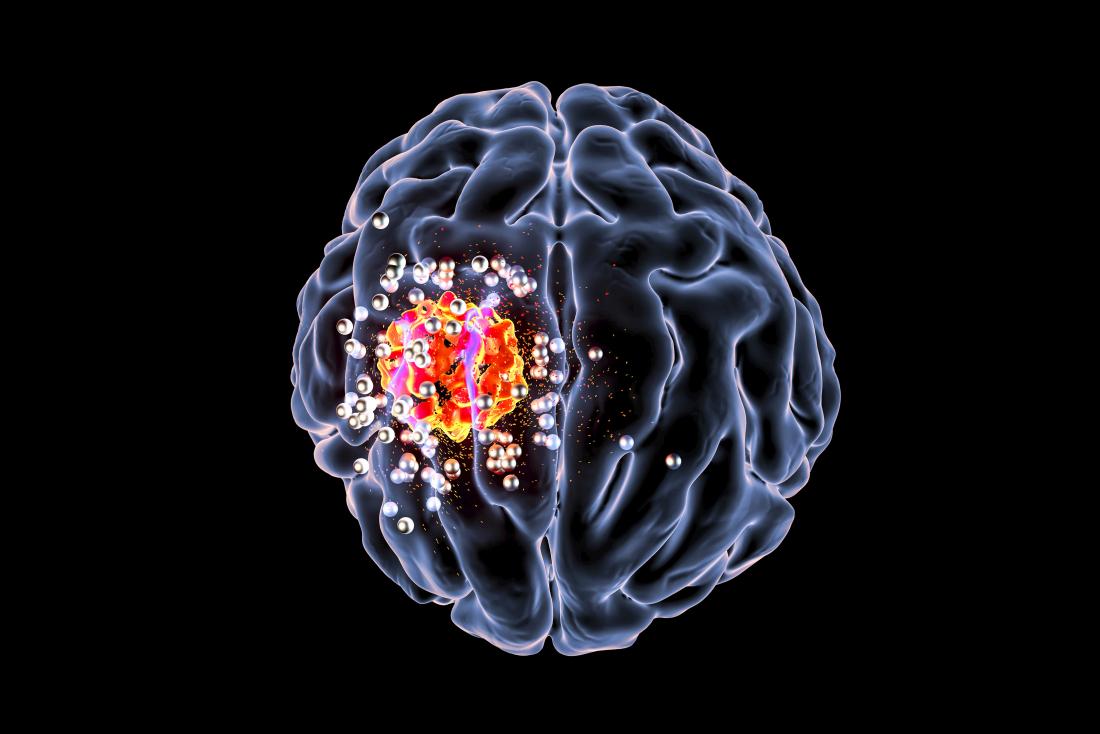 4 maneiras bem-sucedidas de tratar tumores cerebrais