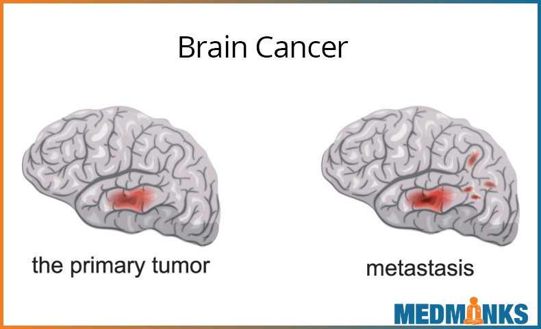 signs-symptoms-brain-tumor-cancer