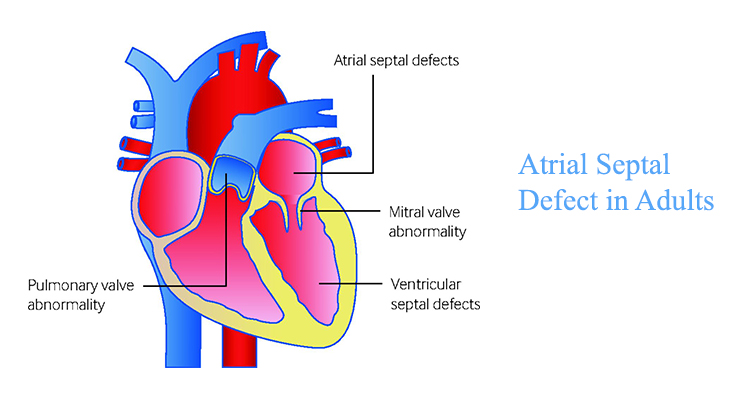 atrial-septal-defect-in-adults