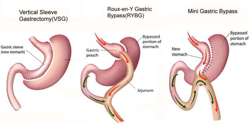types-bariatric-surgery-weight-loss-management