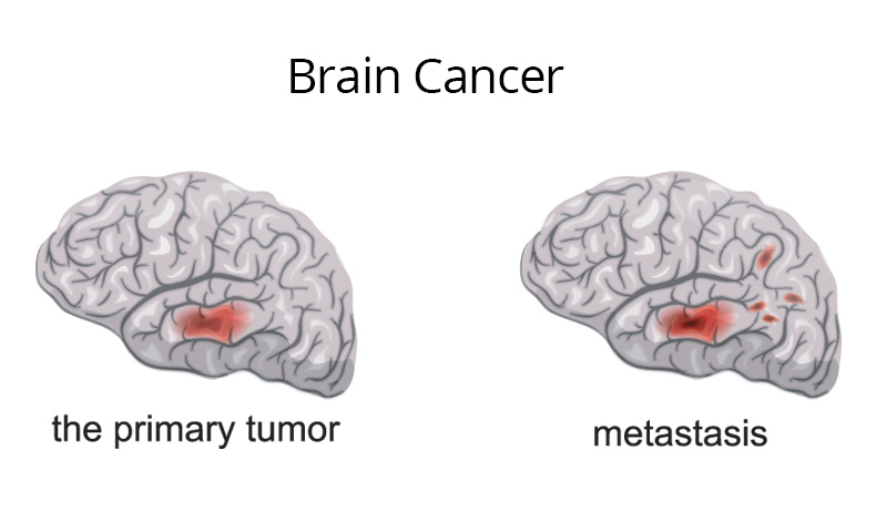 علائم-علائم-تومور مغزی-سرطان