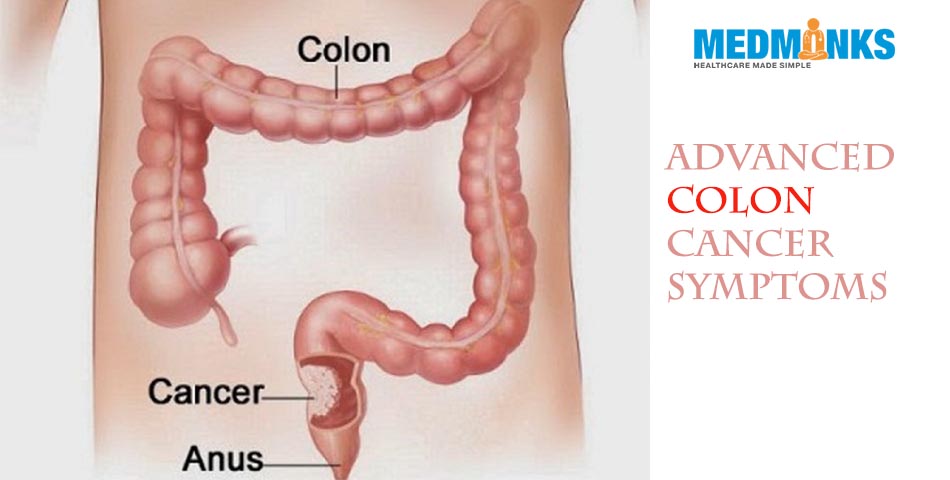 advanced-colon-cancer-symptoms