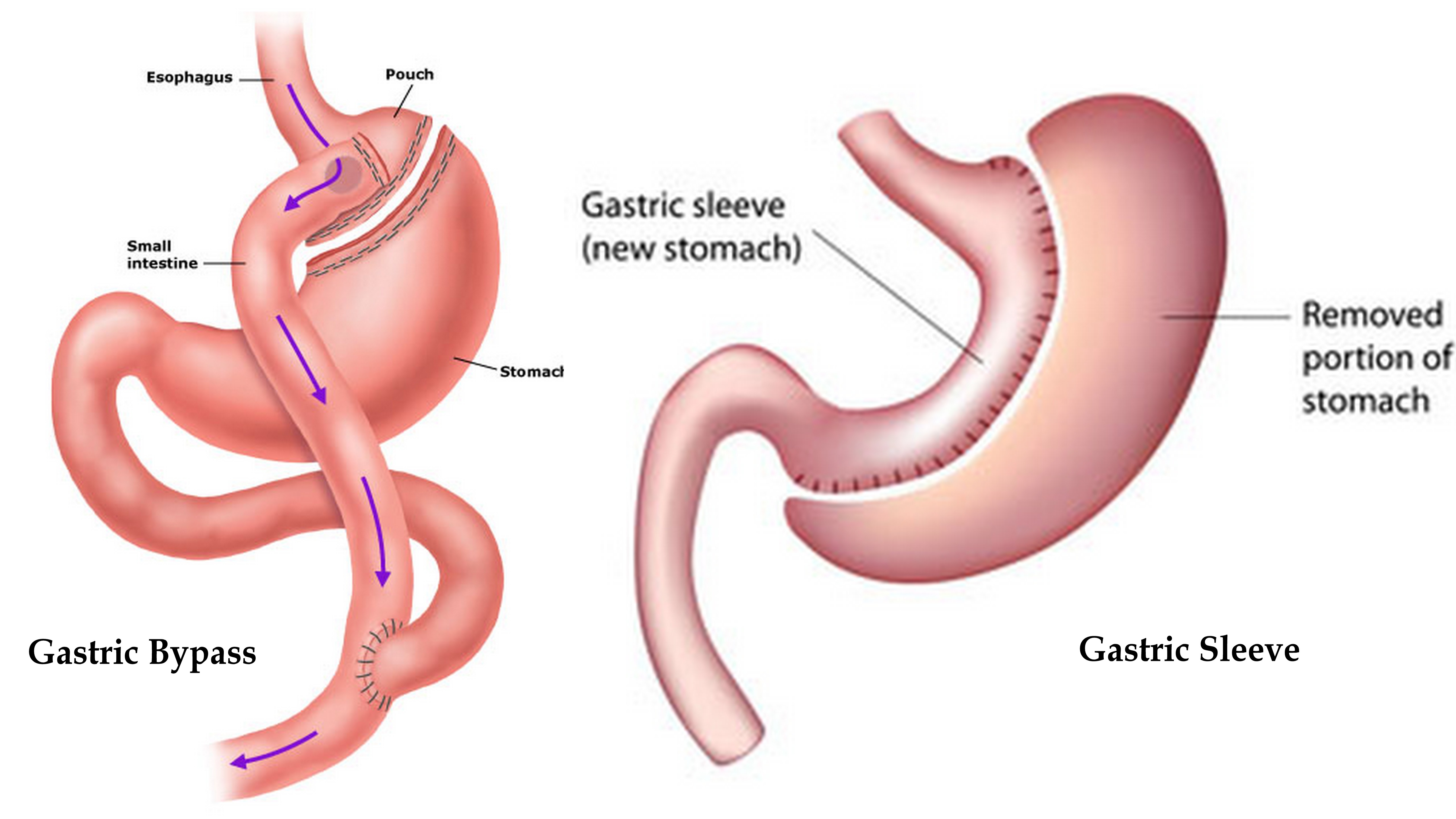 sleeve-gastrectomy-cost-india