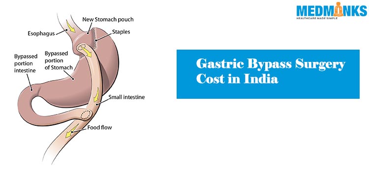 gastric-bypass-surgery-cost-india