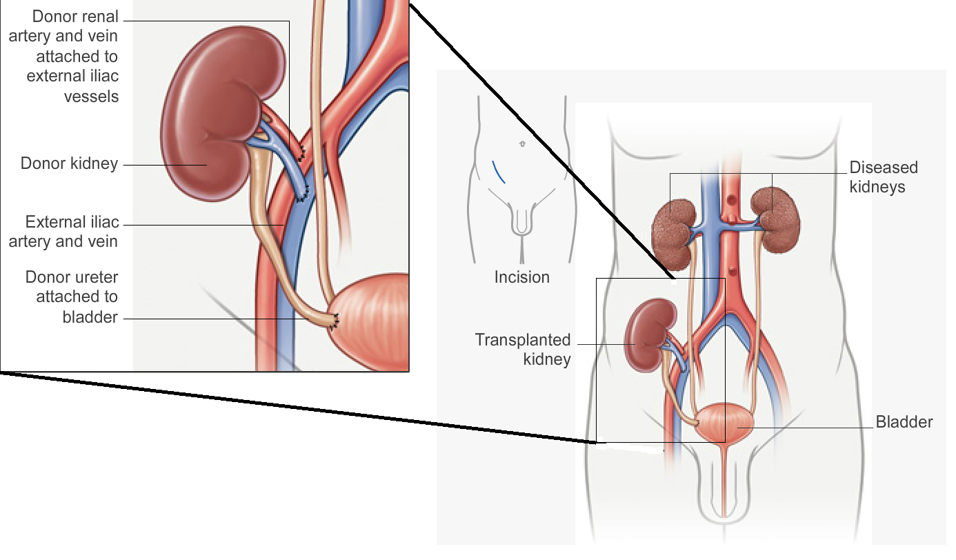 kidney-transplant-procedure-step-by-step