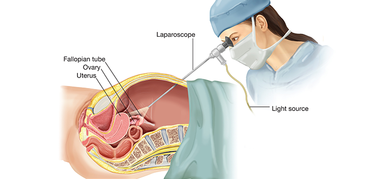 لاپاراسکوپی-جراحی-هزینه-هند