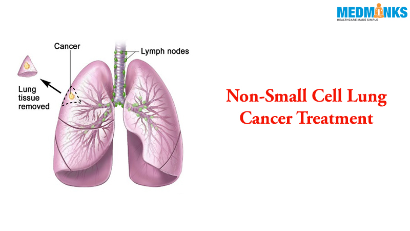 علاج سرطان الرئة ذو الخلايا غير الصغيرة