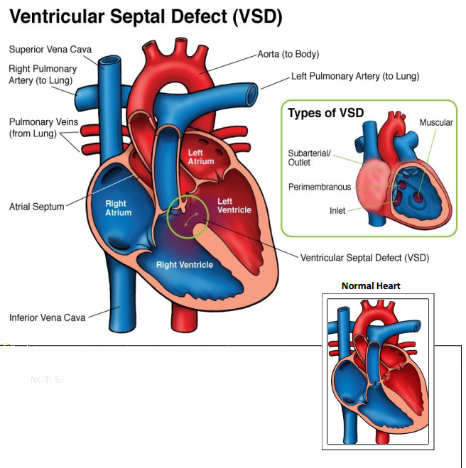 ne-ventrikularni-septalni-defekt-vsd-opasan-5-manje-poznatih-činjenica