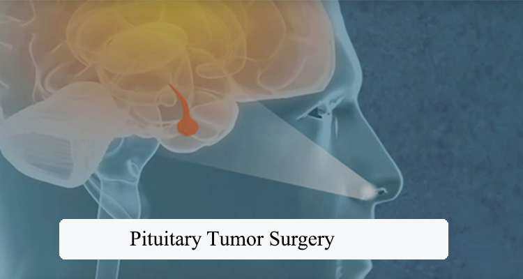 after pituitary tumor removal