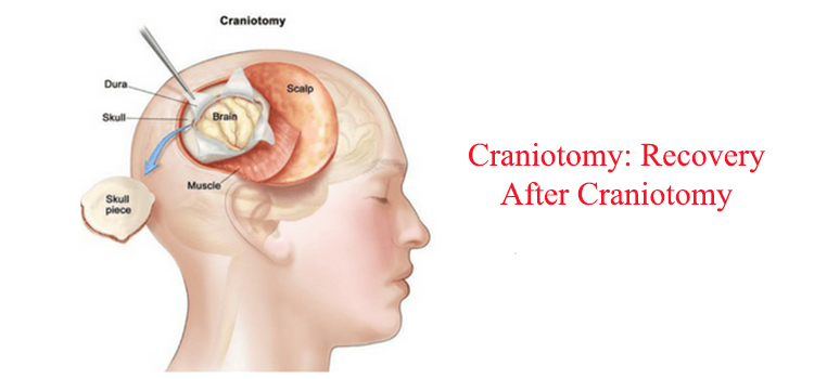 recovery-after-craniotomy
