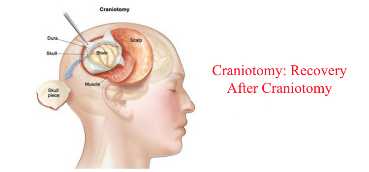 بهبودی پس از کرانیوتومی