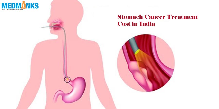 هزینه درمان سرطان معده در هند