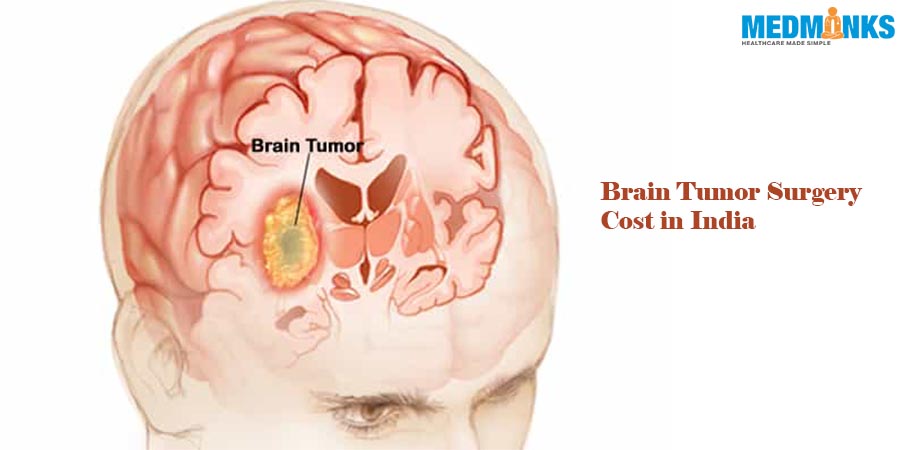 هزینه جراحی تومور مغزی در هند