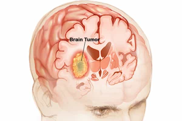 cirurgia de tumor cerebral-índia-custo-top-hospitais-cirurgiões