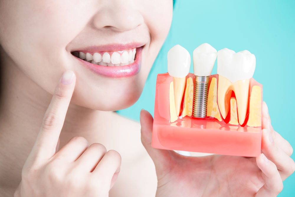 انواع - ایمپلنت های دندانی