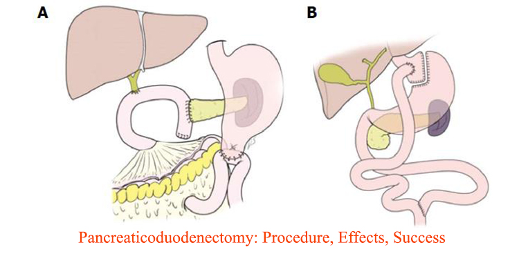 Pancreaticoduodenectomy: Procedure, Effects, Success Rate, & Cost
